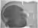 Fig. 01 - METHOD OF TREATING GLIOBLASTOMA