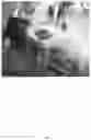 Fig. 05 - METHOD OF TREATING GLIOBLASTOMA