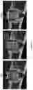 Fig. 02 - METHOD FOR BONE HEALING OR TREATMENT OF BONE FRACTURE