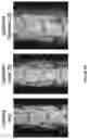 Fig. 31 - METHOD FOR BONE HEALING OR TREATMENT OF BONE FRACTURE