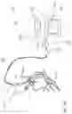 Fig. 17 - CATHETER INFLATABLE CUFF PRESSURE-SENSING DEVICES