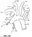 Fig. 07 - TRANS-RADIAL ACCESS ENDOVASCULAR CATHETERS AND METHODS OF USE