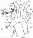 Fig. 08 - TRANS-RADIAL ACCESS ENDOVASCULAR CATHETERS AND METHODS OF USE