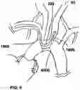 Fig. 11 - TRANS-RADIAL ACCESS ENDOVASCULAR CATHETERS AND METHODS OF USE