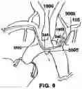 Fig. 12 - TRANS-RADIAL ACCESS ENDOVASCULAR CATHETERS AND METHODS OF USE