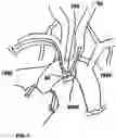 Fig. 13 - TRANS-RADIAL ACCESS ENDOVASCULAR CATHETERS AND METHODS OF USE