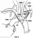 Fig. 14 - TRANS-RADIAL ACCESS ENDOVASCULAR CATHETERS AND METHODS OF USE
