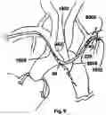 Fig. 15 - TRANS-RADIAL ACCESS ENDOVASCULAR CATHETERS AND METHODS OF USE