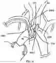 Fig. 16 - TRANS-RADIAL ACCESS ENDOVASCULAR CATHETERS AND METHODS OF USE