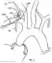 Fig. 17 - TRANS-RADIAL ACCESS ENDOVASCULAR CATHETERS AND METHODS OF USE