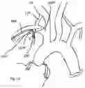 Fig. 18 - TRANS-RADIAL ACCESS ENDOVASCULAR CATHETERS AND METHODS OF USE