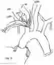 Fig. 19 - TRANS-RADIAL ACCESS ENDOVASCULAR CATHETERS AND METHODS OF USE