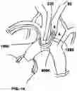 Fig. 20 - TRANS-RADIAL ACCESS ENDOVASCULAR CATHETERS AND METHODS OF USE
