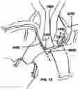 Fig. 21 - TRANS-RADIAL ACCESS ENDOVASCULAR CATHETERS AND METHODS OF USE