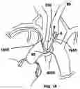 Fig. 22 - TRANS-RADIAL ACCESS ENDOVASCULAR CATHETERS AND METHODS OF USE
