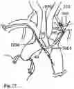Fig. 23 - TRANS-RADIAL ACCESS ENDOVASCULAR CATHETERS AND METHODS OF USE