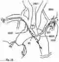 Fig. 24 - TRANS-RADIAL ACCESS ENDOVASCULAR CATHETERS AND METHODS OF USE