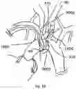 Fig. 25 - TRANS-RADIAL ACCESS ENDOVASCULAR CATHETERS AND METHODS OF USE