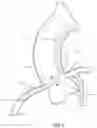 Fig. 03 - Microfabricated catheter having an intermediate preferred bending section