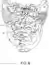 Fig. 10 - MICROCATHETER FOR THERAPEUTIC AND/OR DIAGNOSTIC INTERVENTIONS IN THE SUBARACHNOID SPACE