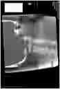 Fig. 12 - MICROCATHETER FOR THERAPEUTIC AND/OR DIAGNOSTIC INTERVENTIONS IN THE SUBARACHNOID SPACE