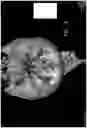 Fig. 13 - MICROCATHETER FOR THERAPEUTIC AND/OR DIAGNOSTIC INTERVENTIONS IN THE SUBARACHNOID SPACE