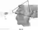 Fig. 22 - SYSTEMS AND METHODS FOR CRANIOCERVICAL AND AURICULAR NEUROMODULATION
