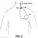 Fig. 03 - TREATING INFLAMMATORY DISORDERS BY STIMULATION OF THE CHOLINERGIC ANTI-INFLAMMATORY PATHWAY