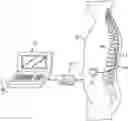 Fig. 01 - Neuromodulation using modulated pulse train