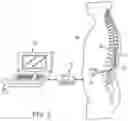 Fig. 03 - Neuromodulation using modulated pulse train