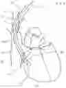 Fig. 06 - CURLED SHAFT TEMPORARY PACING LEAD