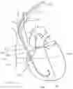 Fig. 09 - CURLED SHAFT TEMPORARY PACING LEAD