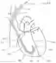 Fig. 10 - CURLED SHAFT TEMPORARY PACING LEAD