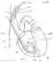 Fig. 11 - CURLED SHAFT TEMPORARY PACING LEAD