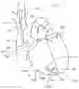 Fig. 26 - CURLED SHAFT TEMPORARY PACING LEAD