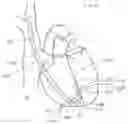Fig. 27 - CURLED SHAFT TEMPORARY PACING LEAD