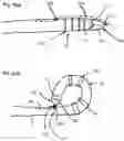 Fig. 32 - CURLED SHAFT TEMPORARY PACING LEAD