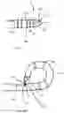 Fig. 33 - CURLED SHAFT TEMPORARY PACING LEAD