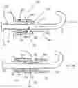 Fig. 35 - CURLED SHAFT TEMPORARY PACING LEAD