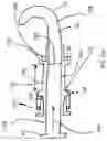 Fig. 36 - CURLED SHAFT TEMPORARY PACING LEAD