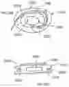 Fig. 49 - CURLED SHAFT TEMPORARY PACING LEAD