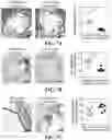 Fig. 20 - CHEMICALLY PROGRAMMED NEUTROPHILS AND USES THEREOF