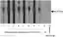 Fig. 01 - ASSESSING AND TREATING GERM CELL TUMORS AND PARANEOPLASTIC AUTOIMMUNITY