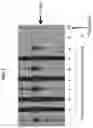 Fig. 02 - ASSESSING AND TREATING GERM CELL TUMORS AND PARANEOPLASTIC AUTOIMMUNITY