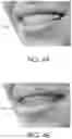 Fig. 05 - Automated braces removal from images
