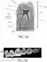 Fig. 06 - Automated braces removal from images