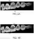 Fig. 07 - Automated braces removal from images