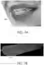 Fig. 08 - Automated braces removal from images