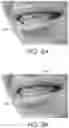 Fig. 10 - Automated braces removal from images