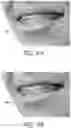 Fig. 11 - Automated braces removal from images